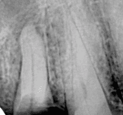 Surgical Extractions: Step by Step Presentation Series