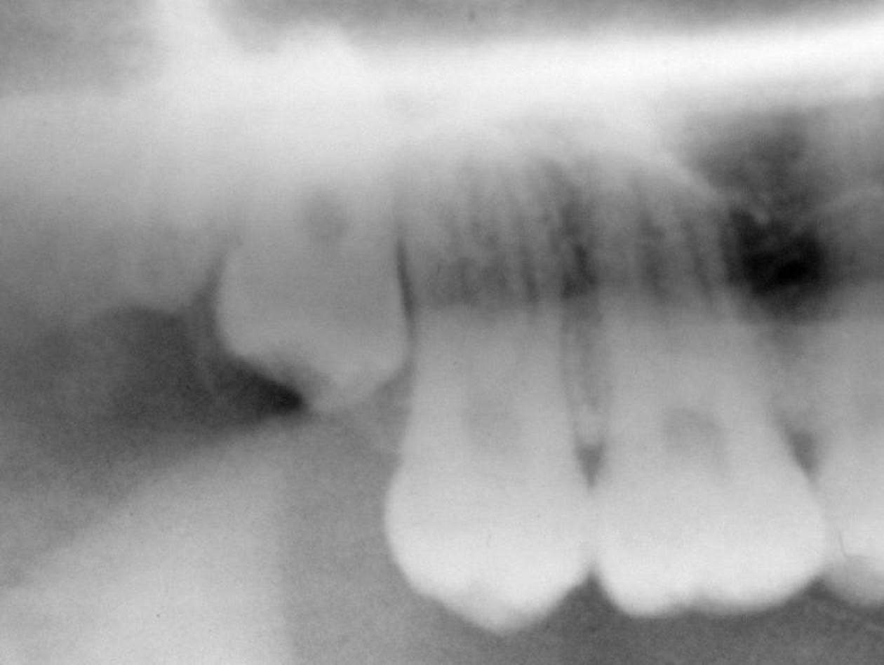 Third Molar Impaction Surgery Course – September 8, 9, 11, 2021 ...