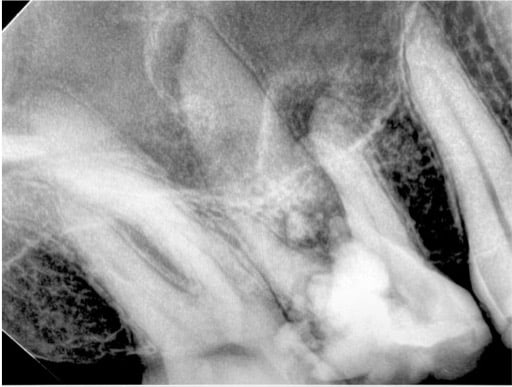 You are currently viewing Maxillary 1st molar extraction – Dental Case