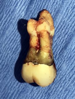 Read more about the article How to recognize red flags in Dental Extractions