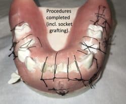 Read more about the article How does one do more surgical extractions in general practice and do them quickly and safely with minimal bone loss?