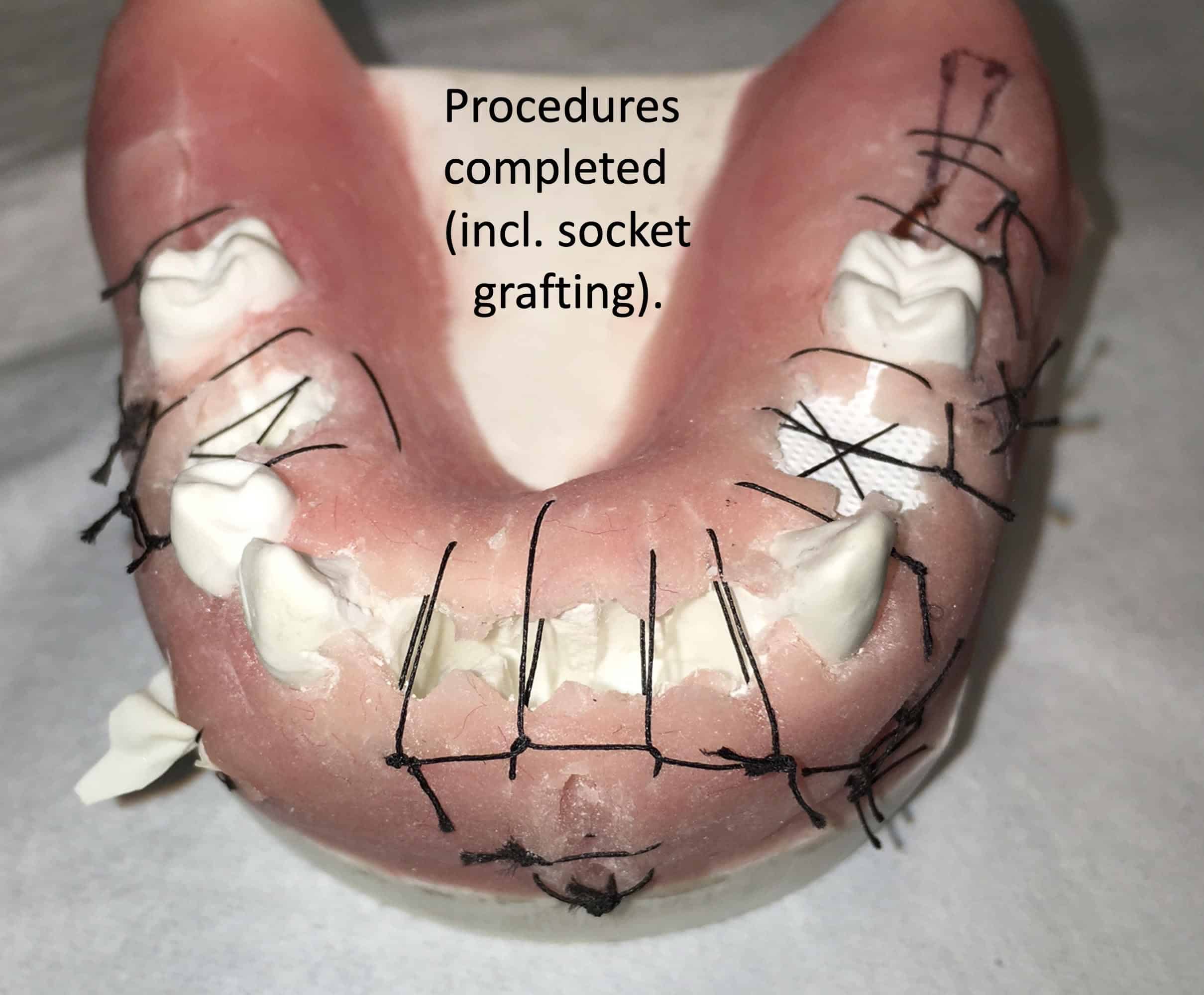 Read more about the article How does one do more surgical extractions in general practice and do them quickly and safely with minimal bone loss?