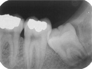Introduction to Moderate Third Molar Surgery Impactions